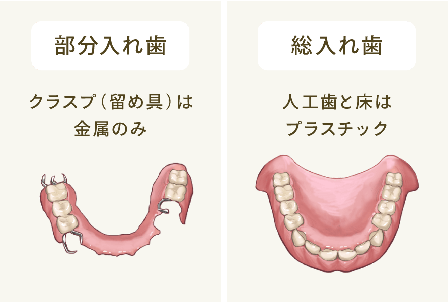 部分入れ歯：クラスプ（留め具）は金属のみ/総入れ歯：人工歯と床はプラスチック