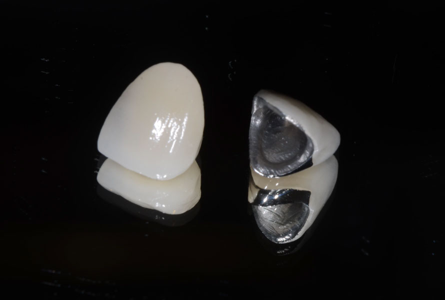 メタルボンド(クラウン)