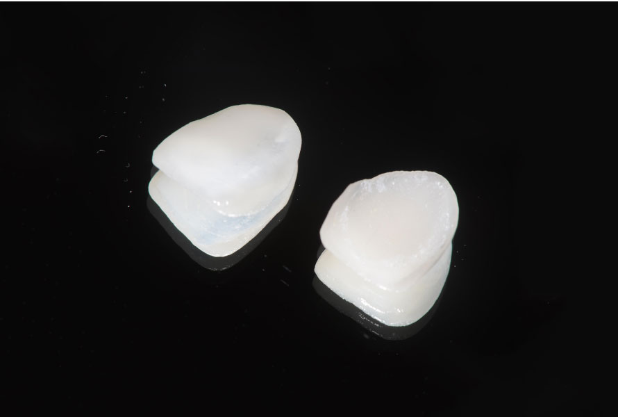 ラミネートベニア