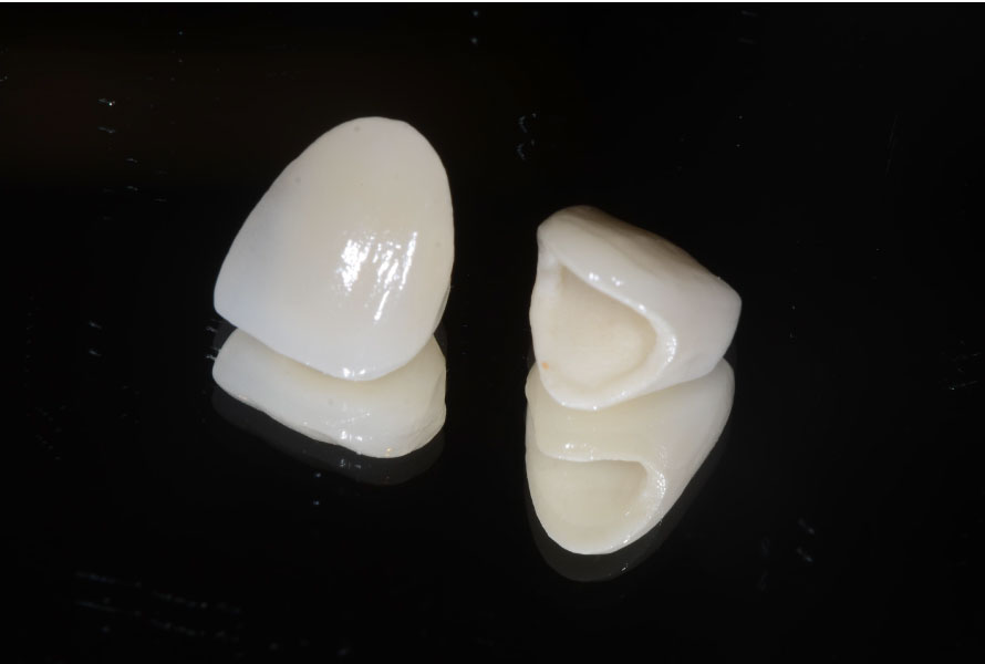 ジルコニアセラミック(クラウン)